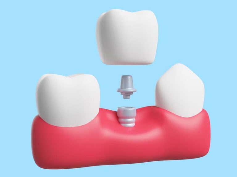 Implant Surgical Guide in Ahwatukee, Phoenix, AZ