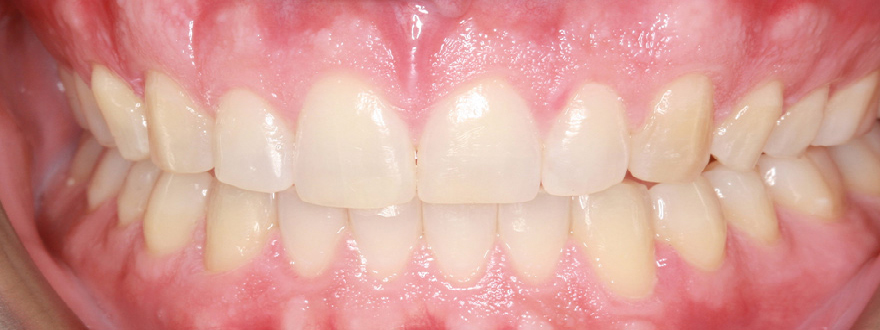 Invisalign / Aligners before after