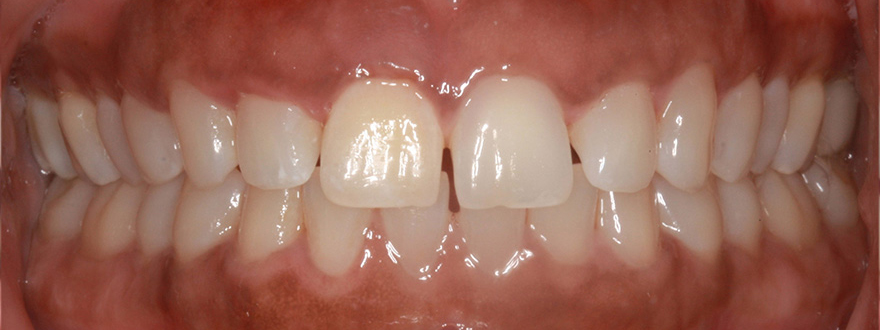 Invisalign / Aligners before after