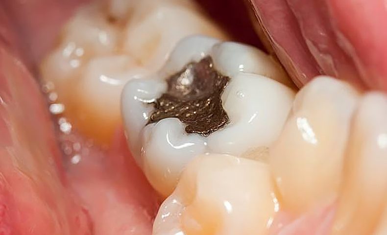 How Common Are Cavity Fillings?