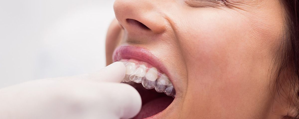 Is 20 Hours Enough for Invisalign