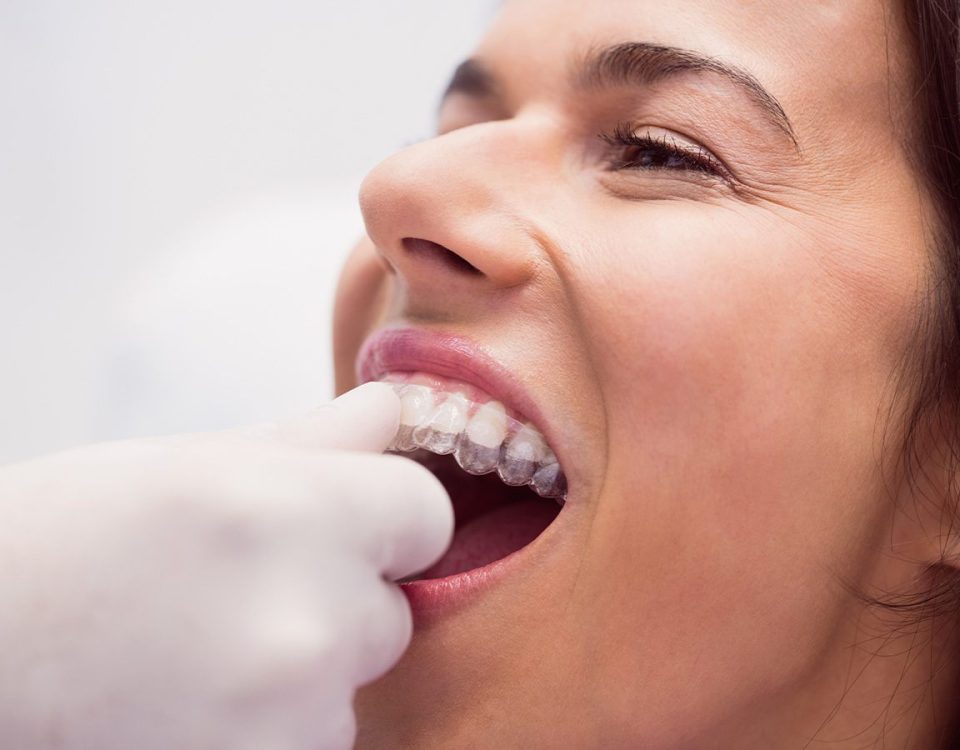 Is 20 Hours Enough for Invisalign