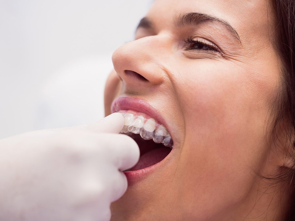 Is 20 Hours Enough for Invisalign