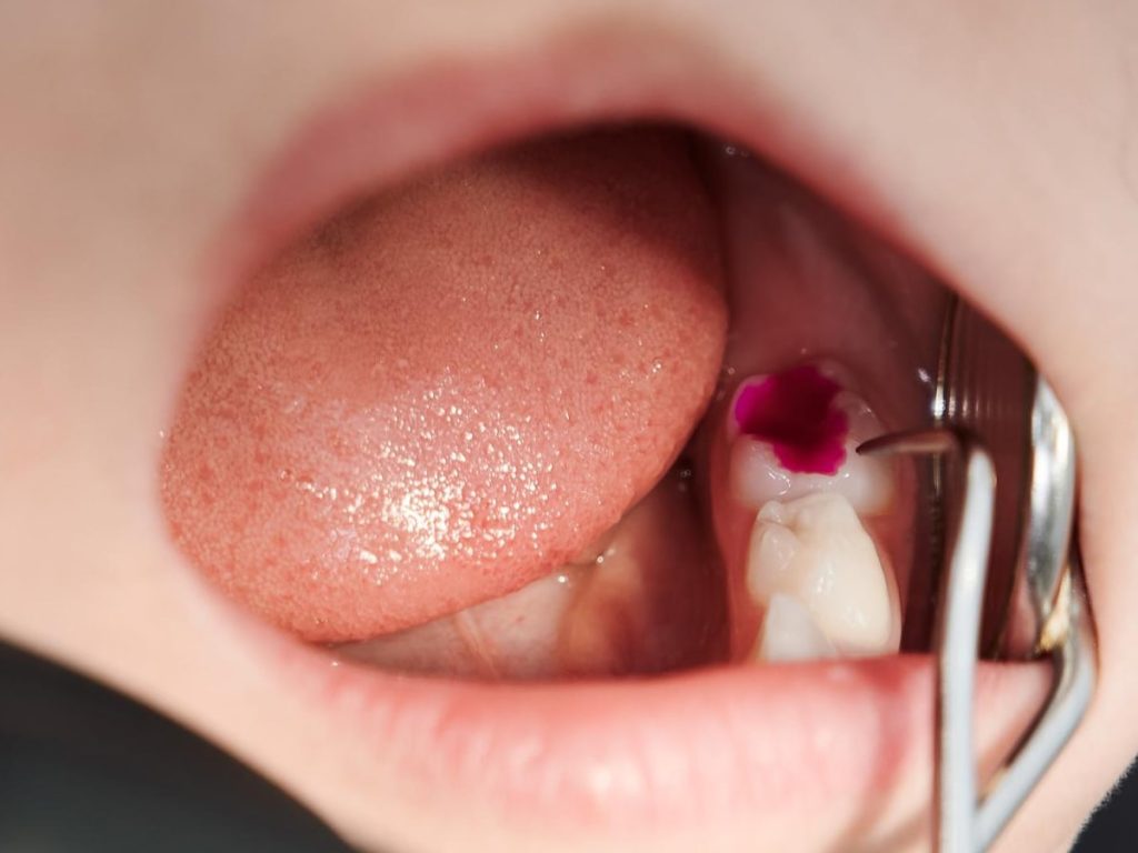 How Long Does it Take a Cavity to Form?