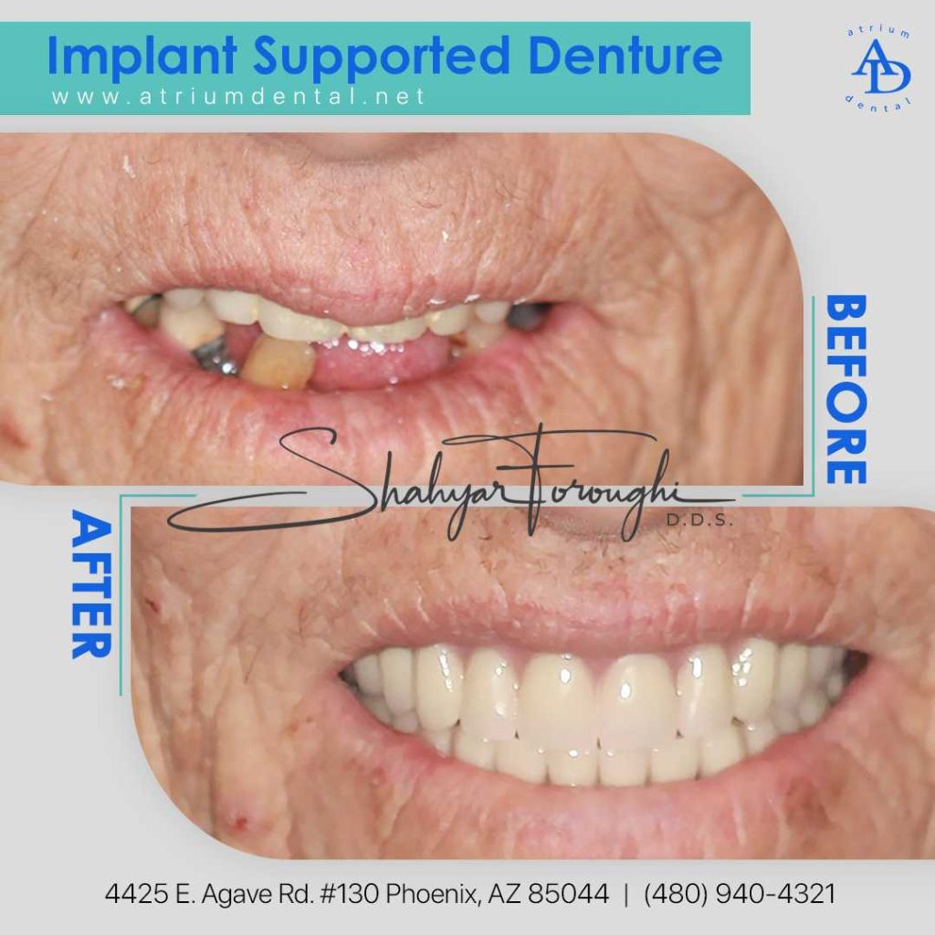 Implant Supported Denturebeforeafter