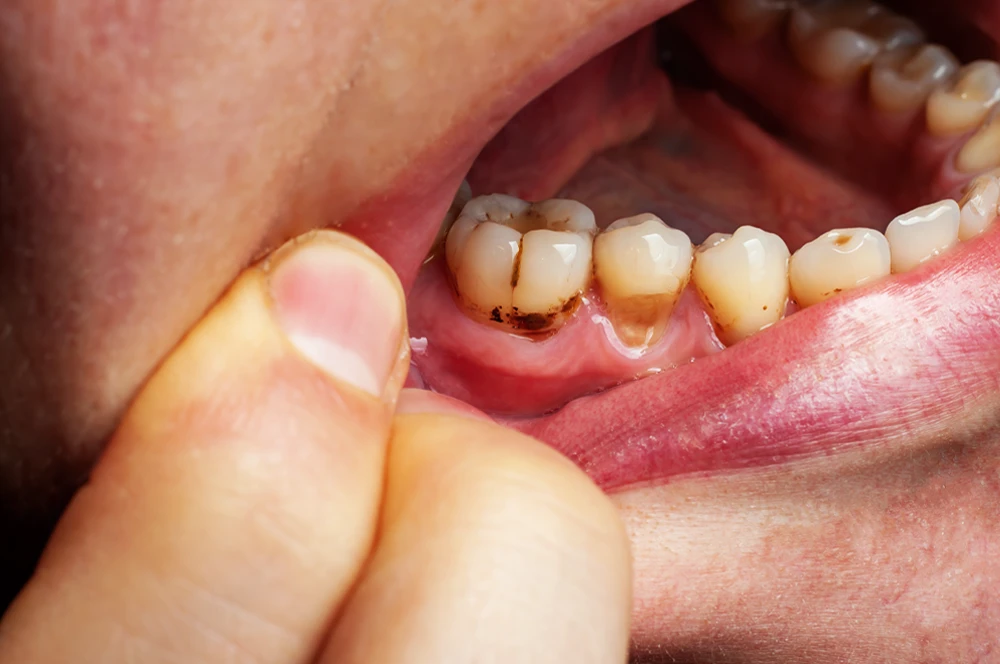 Which Cavities Hurt the Most?