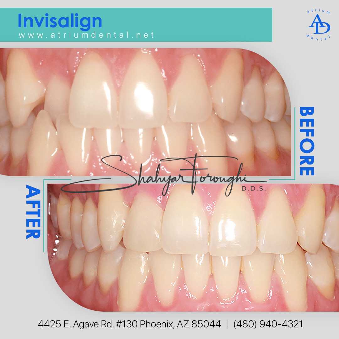 Invisalign