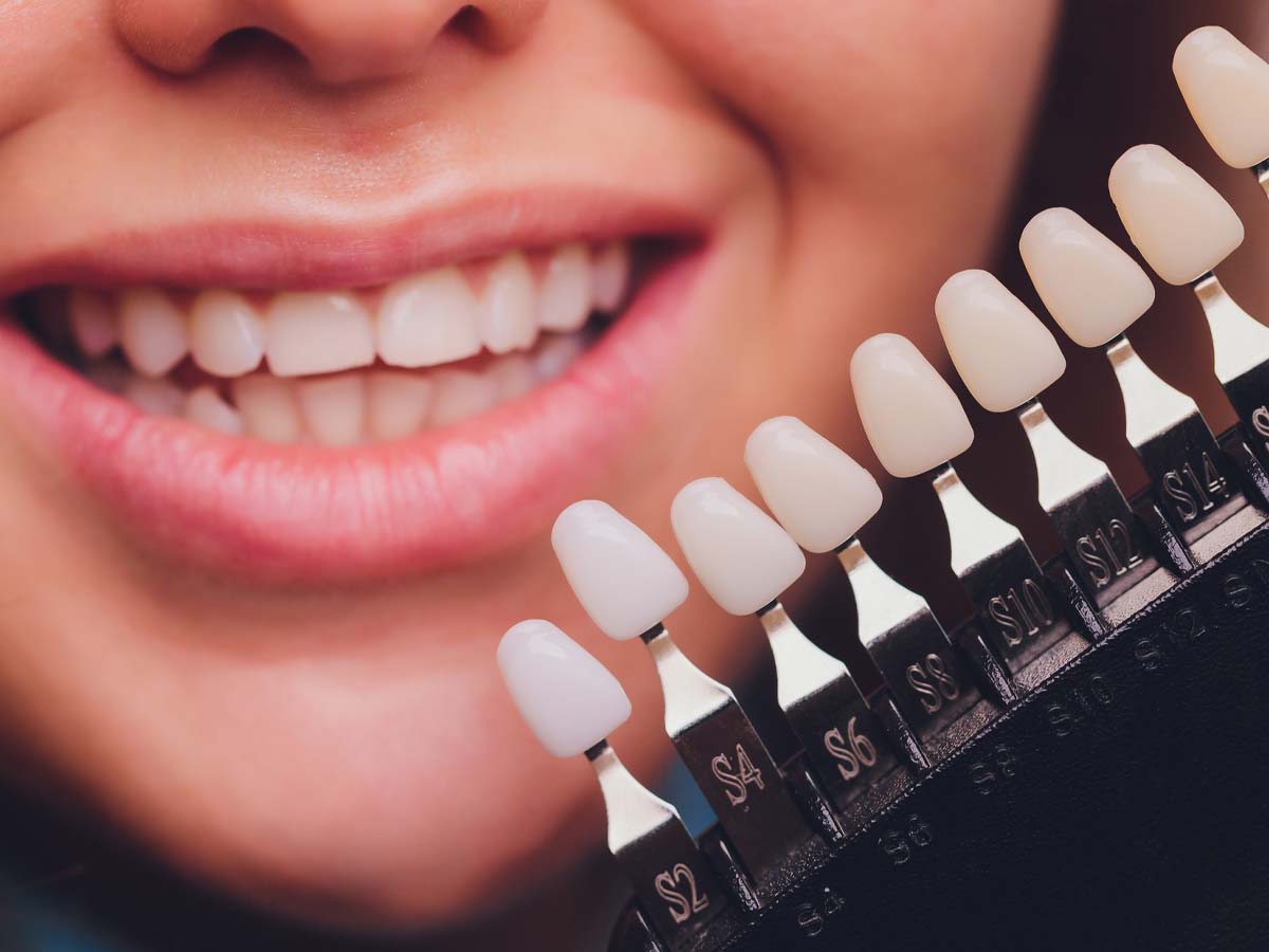 Do Veneers Look Like Real Teeth