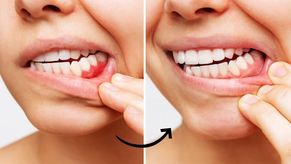 Can You Regrow Gum Tissue?