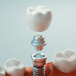 One-Stage vs. Two-Stage Dental Implant, What are the Differences