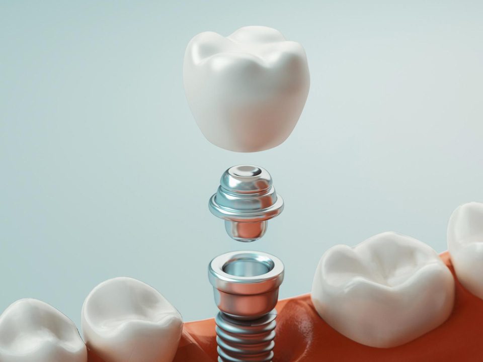 One-Stage vs. Two-Stage Dental Implant, What are the Differences