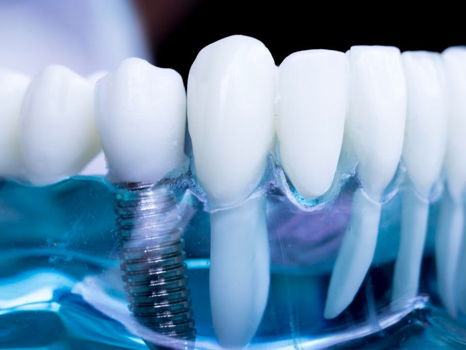 What are the Parts of a Dental Implant