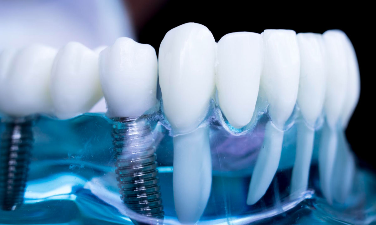 What are the 3 Parts of a Dental Implant?