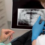 Root Canal vs. Implant; Which one to Choose