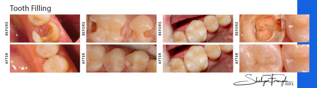 before afters Tooth Filling