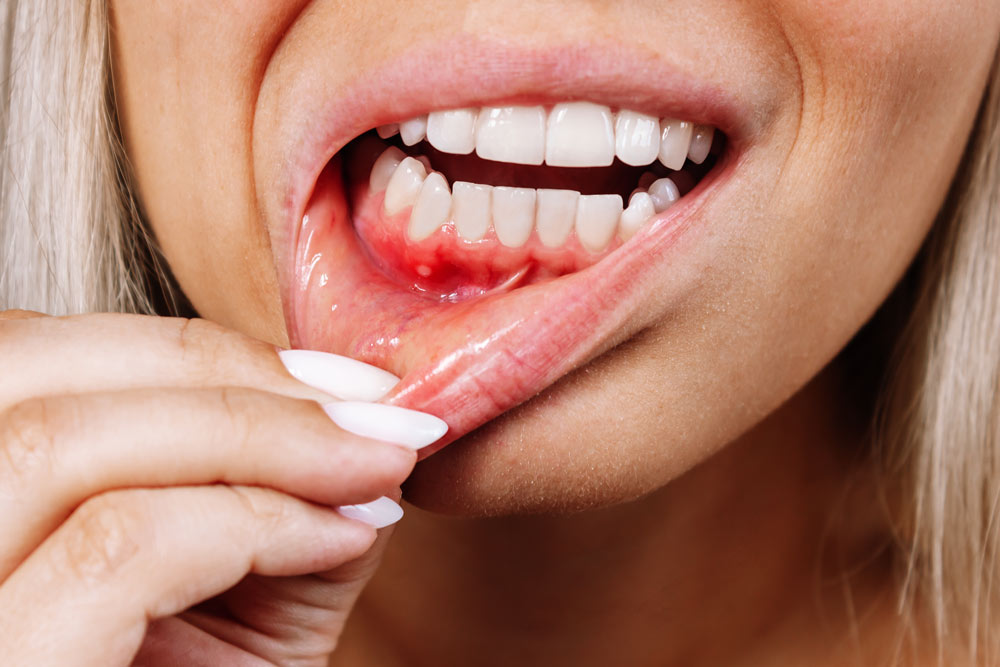Burned Gums from Teeth Whitening
