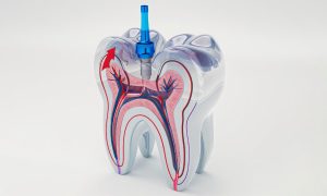 Effective Tips for Root Canal After-Care