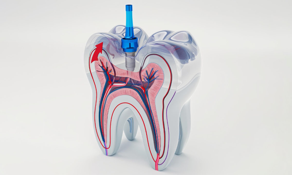 Effective Tips for Root Canal After-Care