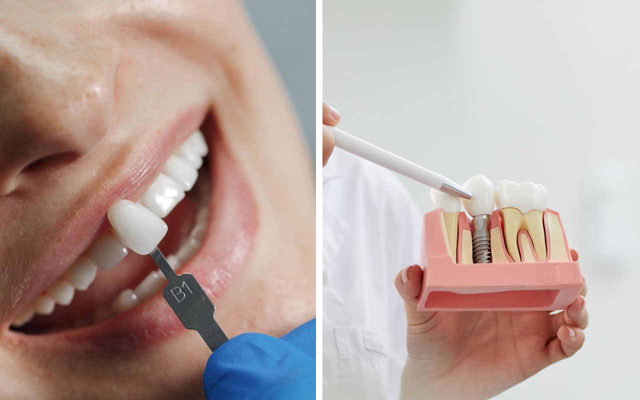 Veneers vs. Lumineers Cost, Difference, Pros and Cons