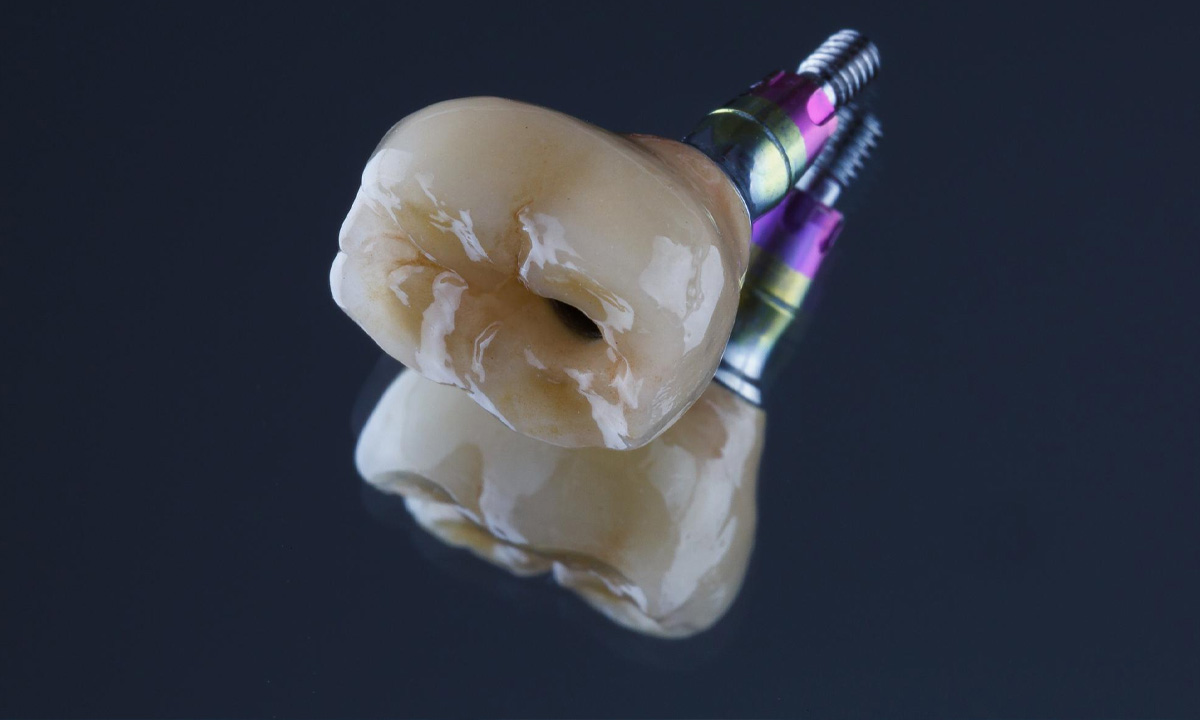 Single Tooth Dental Implants