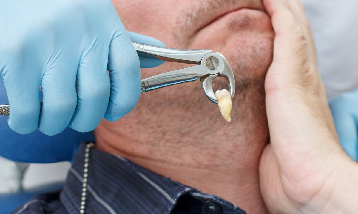 Can I Wear My Retainer After Wisdom Teeth Removal