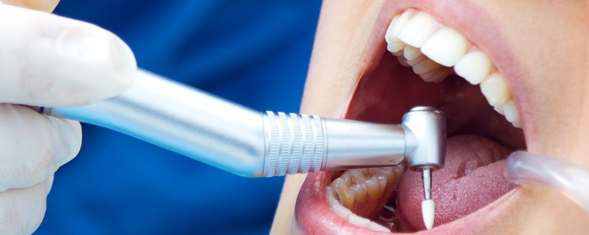Are Dental Fillings Permanent?