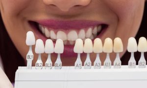 How Long Do Dental Veneers Last?