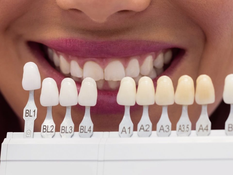 How Long Do Dental Veneers Last?