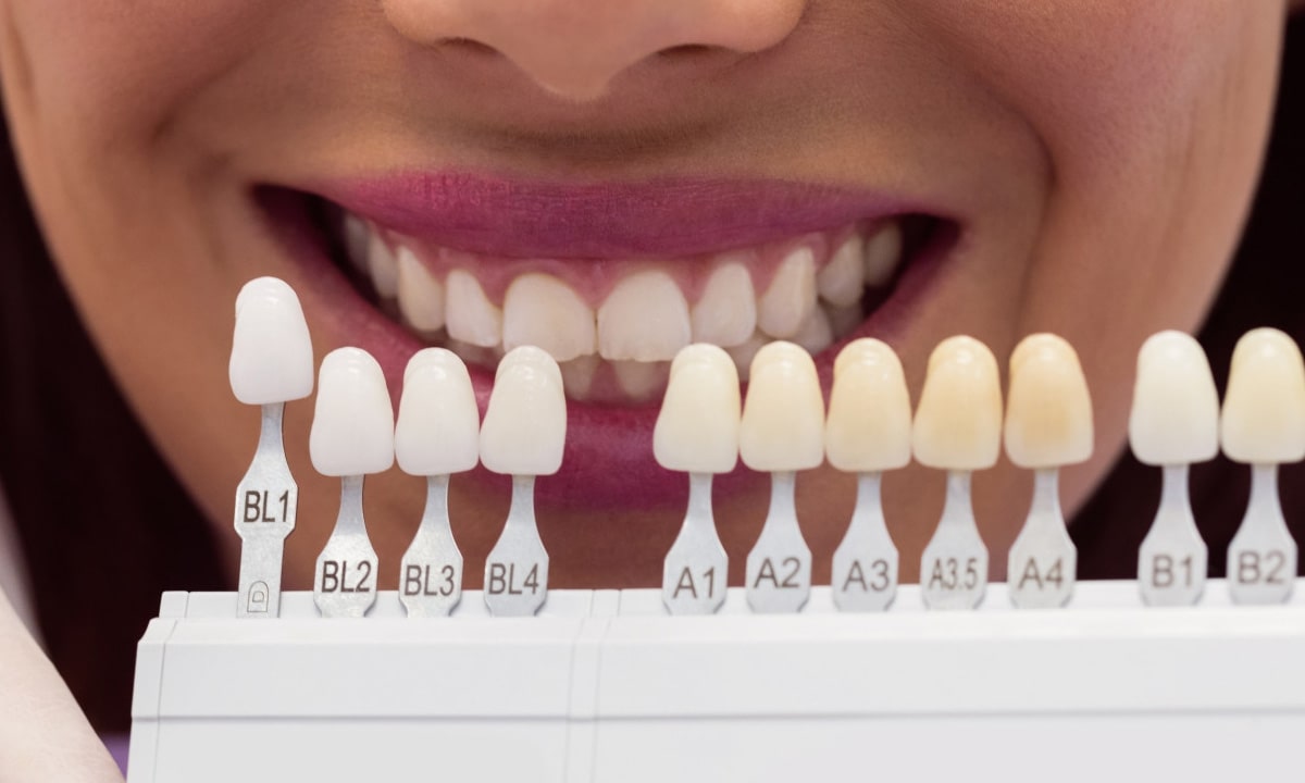 How Long Do Dental Veneers Last?