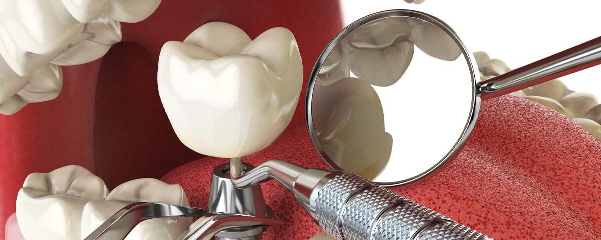 How Painful Is Tooth Implant Surgery