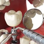 How Painful Is Tooth Implant Surgery