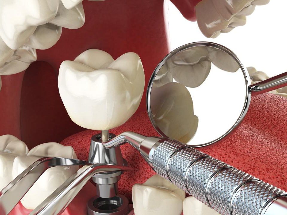 How Painful Is Tooth Implant Surgery