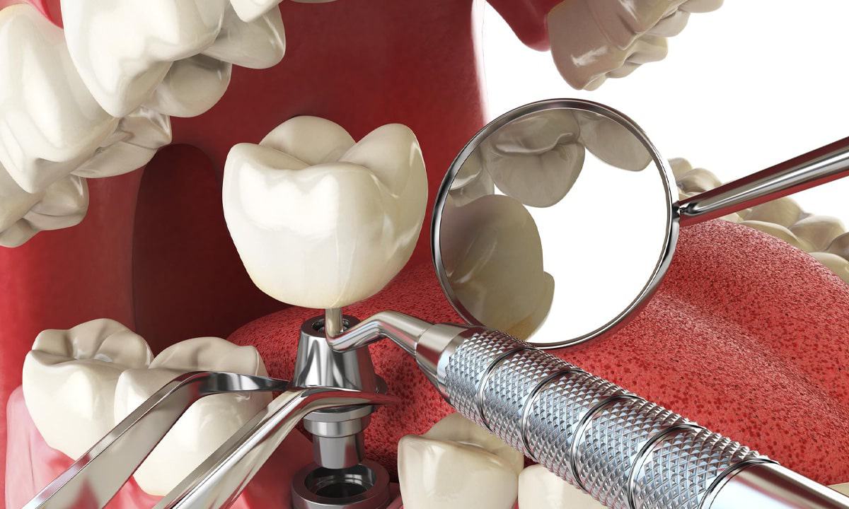 How Painful Is Tooth Implant Surgery