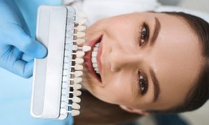 Benefits of Composite Veneers Over Porcelain Veneers