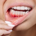 8 Ways to Prevent Gum Fibromas