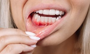 8 Ways to Prevent Gum Fibromas