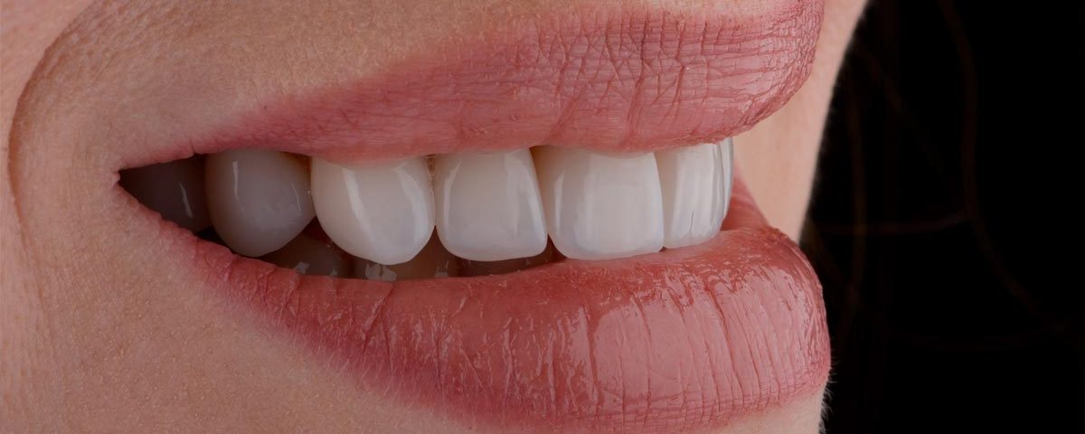 How Long Do Prepless Veneers Last?