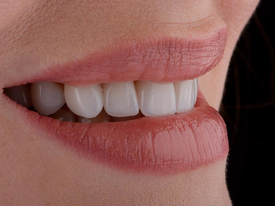 How Long Do Prepless Veneers Last?