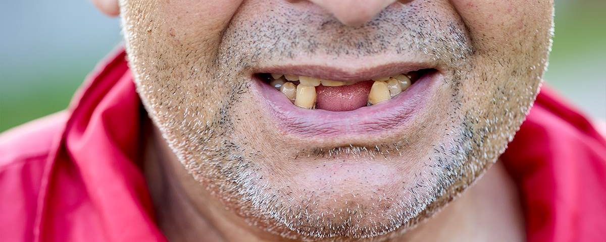 Tooth Loss in Adults: Causes and Solutions