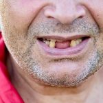 Tooth Loss in Adults: Causes and Solutions