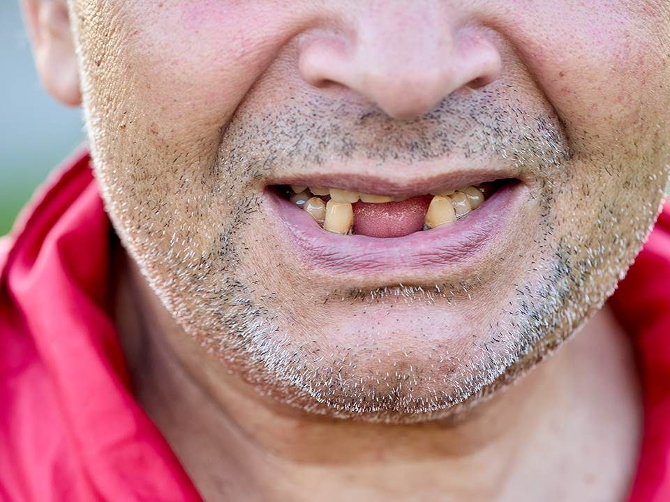 Tooth Loss in Adults: Causes and Solutions