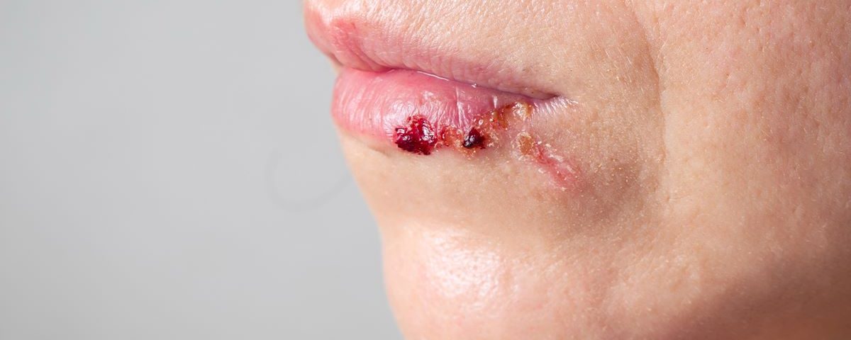 Venous Lake Lip vs Melanoma: The Differences