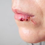 Venous Lake Lip vs Melanoma: The Differences