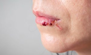 Venous Lake Lip vs Melanoma: The Differences