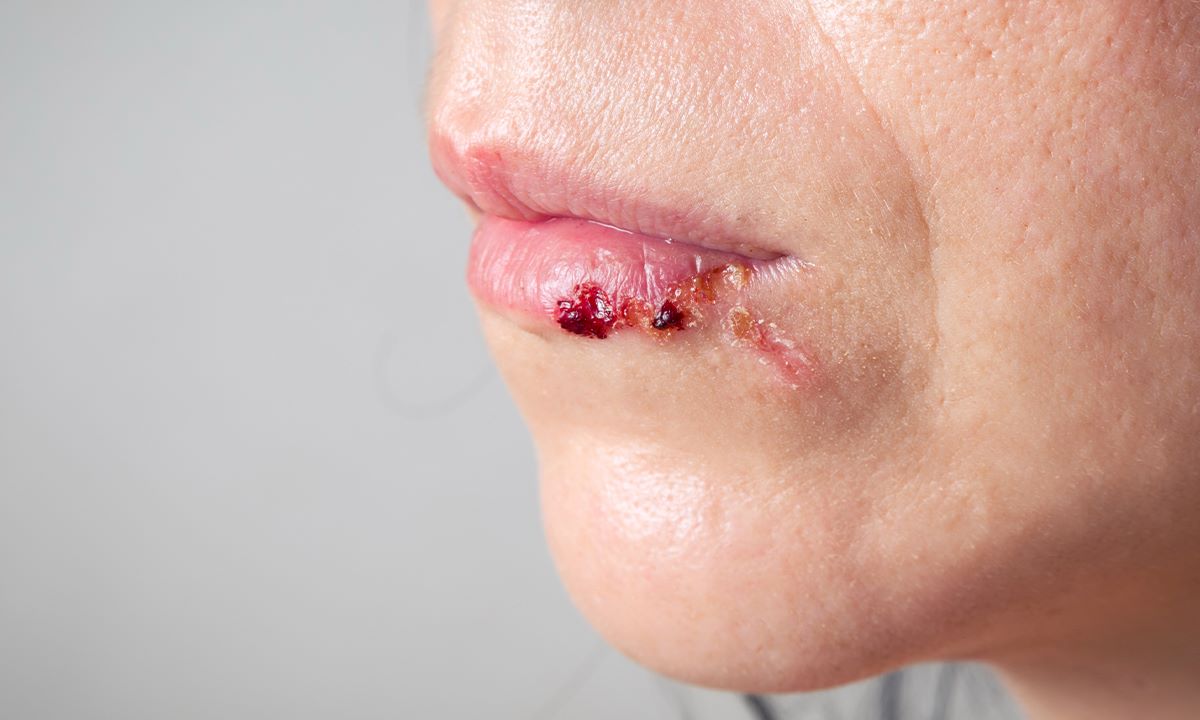 Venous Lake Lip vs Melanoma: Differences | Atrium Dental