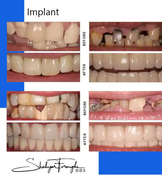Before After Implant