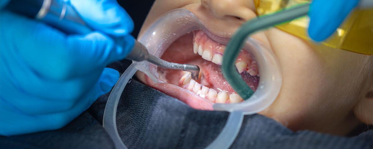 Full Mouth Reconstruction for Bruxism
