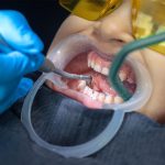 Full Mouth Reconstruction for Bruxism