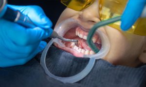 Full Mouth Reconstruction for Bruxism