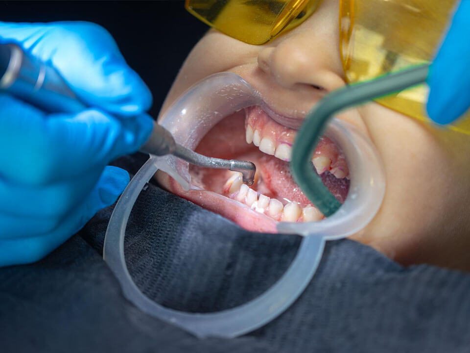 Full Mouth Reconstruction for Bruxism